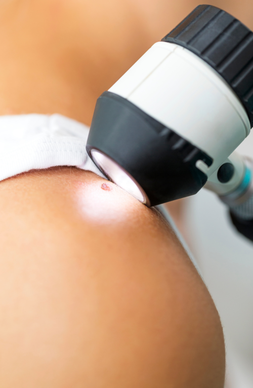 VIDEODERMATOSCOPIA EPILUMINESCENZA